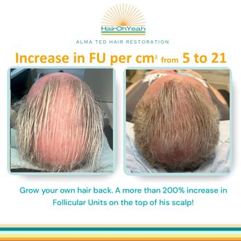 Hair Oh Yeah - Hair Loss Centers Near Me - Bellevue, Washington Hair Oh Yeah - Hair Loss Centers Near Me - Bellevue, Washington