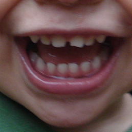 chipped front tooth chipped front tooth