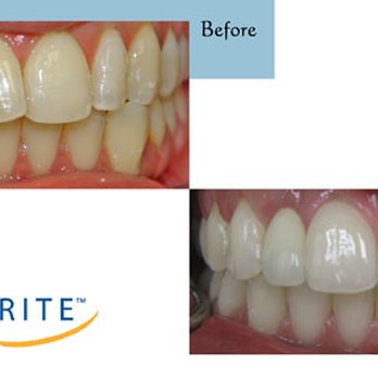White River Family Dentistry - Beautiful Whiter teeth in just 1 hour!! - General Dentistry Near Me - Auburn, Washington White River Family Dentistry - Beautiful Whiter teeth in just 1 hour!! - General Dentistry Near Me - Auburn, Washington