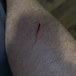 My leg sliced open because the sink was left in the middle of the kitchen floor. My leg sliced open because the sink was left in the middle of the kitchen floor.