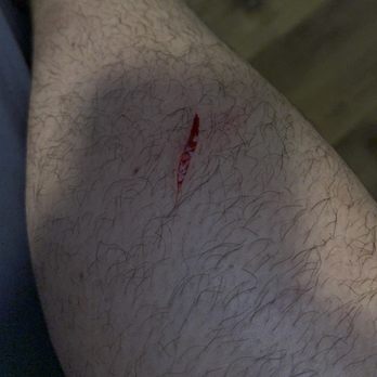 Kustom Disaster Restoration - My leg sliced open because the sink was left in the middle of the kitchen floor. - General Contractors Near Me - Gold River, California Kustom Disaster Restoration - My leg sliced open because the sink was left in the middle of the kitchen floor. - General Contractors Near Me - Gold River, California