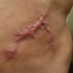 Scars from laser lipo at Atlantis Medical Wellness Center. Scars from laser lipo at Atlantis Medical Wellness Center.
