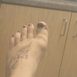 Swenson Foot & Ankle - Before