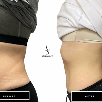 Lovesculpt - Body Contouring Near Me - Irvine, California Lovesculpt - Body Contouring Near Me - Irvine, California