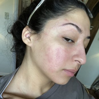 Skin Bar - Right side of my face - Medical Spas Near Me - Dix Hills, New York Skin Bar - Right side of my face - Medical Spas Near Me - Dix Hills, New York
