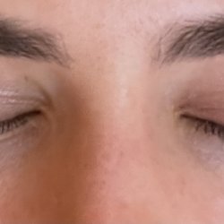 Deka Lash - Swollen right eye