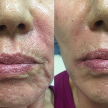 Ageless MD - One syringe of juvaderm makes such a difference. - Medical Spas Near Me - Tustin, California Ageless MD - One syringe of juvaderm makes such a difference. - Medical Spas Near Me - Tustin, California