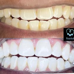 Pearled Teeth Whitening - High Intensity whitening with a 35 Minute session. Pain free Instant Results within Minutes.