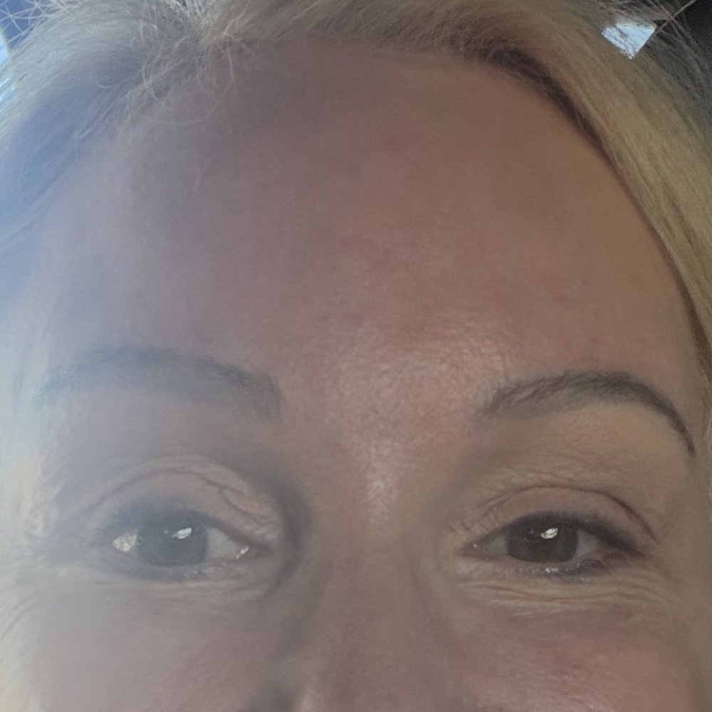 CosMed - 2 weeks post op - Cosmetic Surgeons Near Me - Tijuana, BCN