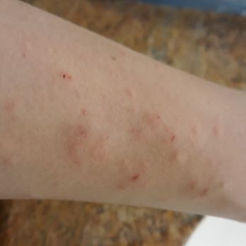 Vacation Rental Authority - Skin irritation - Vacation Rentals Near Me - Coeur d'Alene, Idaho Vacation Rental Authority - Skin irritation - Vacation Rentals Near Me - Coeur d'Alene, Idaho