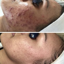 Skintention - Severe inflamed/non-inflamed acne resolved, skin calm and clear.