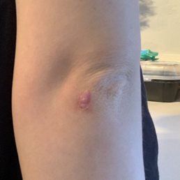 The original scar I had before Dr. Kelly removed it. The original scar I had before Dr. Kelly removed it.