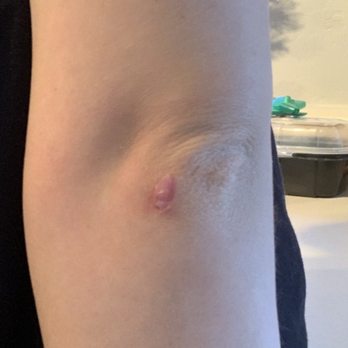 Center for Dermatology & Plastic Surgery - The original scar I had before Dr. Kelly removed it. - Dermatologists Near Me - Gilbert, Arizona Center for Dermatology & Plastic Surgery - The original scar I had before Dr. Kelly removed it. - Dermatologists Near Me - Gilbert, Arizona