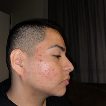 The Peel Connection - Day 1 of my 2nd peel - Skin Care Near Me - Beverly Hills, California