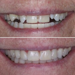 Copp Dental Group - Implants and veneers were used to rejuvenate her smile :)