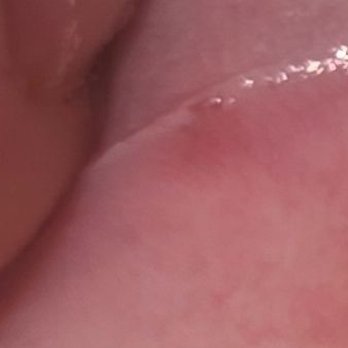 BTX Clinic - Pdo threads ripping through my mouth - Medical Spas Near Me - Monterey Park, California BTX Clinic - Pdo threads ripping through my mouth - Medical Spas Near Me - Monterey Park, California