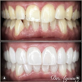 Dentist Near Me Riverside - My before and after results - General Dentistry Near Me - Riverside, California Dentist Near Me Riverside - My before and after results - General Dentistry Near Me - Riverside, California