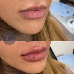 Forever Young Solutions - 1.2 ML of revanesse lips