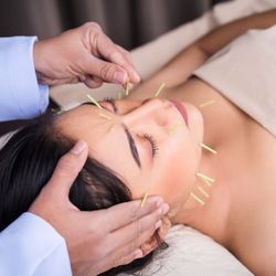 Tensegrity Acupuncture - REJUVENATE FACIAL ACUPUNCTURE