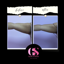 Glam Studios Body Sculpting - Laser Lipo