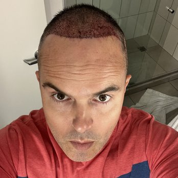 Neopel - After at hotel - Hair Loss Centers Near Me - Tijuana, BCN