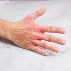 Mobile Skin Screening
