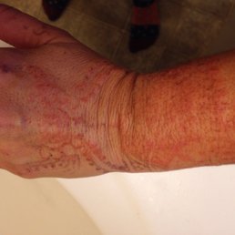 Chemical burn I received from unwittingly getting black Henna from this salon. I thought it was regular Henna.