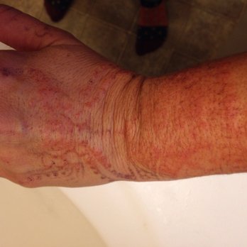 Eyebrow & Lash Art Spa - Chemical burn I received from unwittingly getting black Henna from this salon. I thought it was regular Henna. - Eyebrow Services Near Me - Renton, Washington