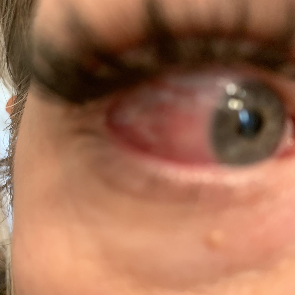 Amazing Lash Studio - Phoenix Eyelash Extensions - Eye trauma from a negligent, inexperienced lash stylist. - Eyelash Service Near Me - Phoenix, Arizona Amazing Lash Studio - Phoenix Eyelash Extensions - Eye trauma from a negligent, inexperienced lash stylist. - Eyelash Service Near Me - Phoenix, Arizona