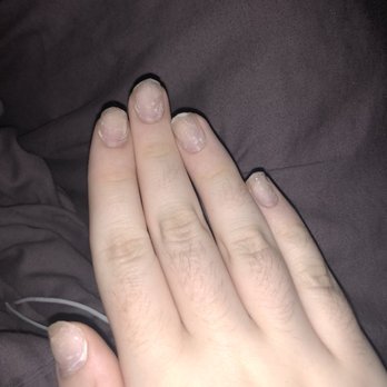 Wonder Nails - My right hand after using acetone to remove the acrylics (pardon my hairy fingers) - Nail Salons Near Me - Audubon, New Jersey Wonder Nails - My right hand after using acetone to remove the acrylics (pardon my hairy fingers) - Nail Salons Near Me - Audubon, New Jersey