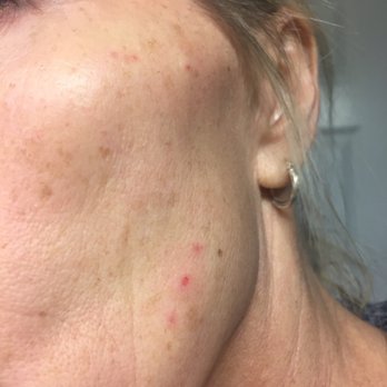 Spa West - some of the deeper burns one week later - Day Spas Near Me - Westlake, Ohio Spa West - some of the deeper burns one week later - Day Spas Near Me - Westlake, Ohio