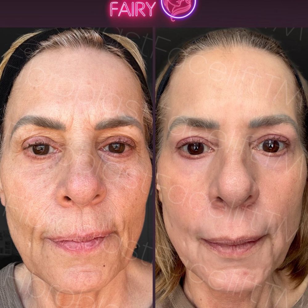 Fibroblast Facelift - Before and after - Skin Care Near Me - Pasadena, California