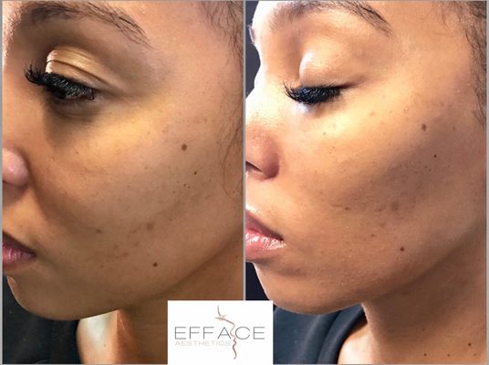 Beauty Injectable Treatments Before & After - Naturally enhancing beautiful features on clients. Less is more at EFFACÉ Aesthetics