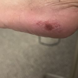 J-nails - Went a little too hard with the "cheese grater" while removing the dead skin off my foot during my pedicure.