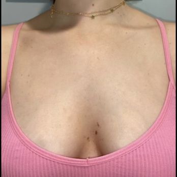 Z. Paul Lorenc, MD, FACS - After results - Cosmetic Surgeons Near Me - New York, New York Z. Paul Lorenc, MD, FACS - After results - Cosmetic Surgeons Near Me - New York, New York