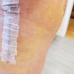 Left hip (and I'm a dude) week of. Some swelling, redness, but normal. Self dissolving stitches.