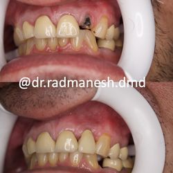 Harmony Dental Care - Santa Clarita - Smile Transformation