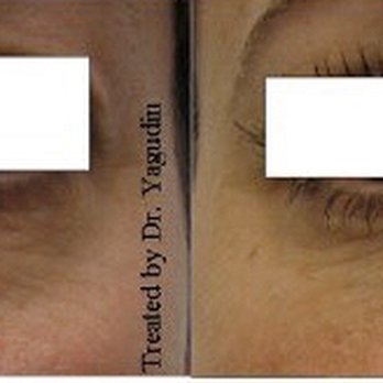 Dermacare Medical - Dark circles under eyes correction with Juvederm - Skin Care Near Me - New York, New York Dermacare Medical - Dark circles under eyes correction with Juvederm - Skin Care Near Me - New York, New York