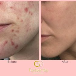 Forever You Aesthetic - Before & After - IPL acne treatment