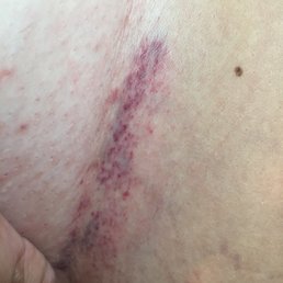 from the brazlian wax... all the way down on both sides