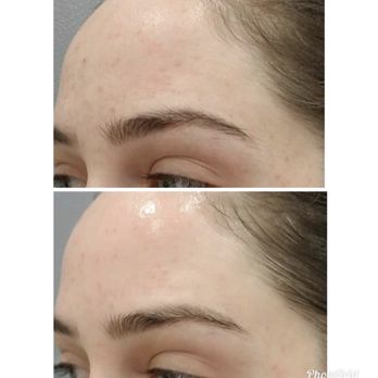 Celeste Rodrigues - Immediately after 1 hydrafacial. - Skin Care Near Me - Beverly Hills, California Celeste Rodrigues - Immediately after 1 hydrafacial. - Skin Care Near Me - Beverly Hills, California