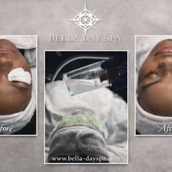 Bella Day Spa - Hydro Dermabrasion Service