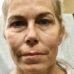 Bridget Briggs, MD - The Briggs Institute of Epigenetic Medicine - Before the fractional CO2 laser