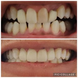 Simarro Brothers Dental Care - Two very old crowns and a dead tooth that had become discolored. I'm in LOVE with the results of my new crowns!