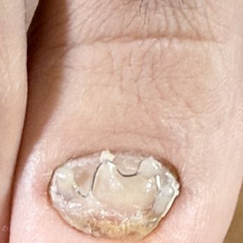 Russian Touch Nails - It's a wire brace. It helps to grow nails with old trauma - Nail Technicians Near Me - Midlothian, Texas Russian Touch Nails - It's a wire brace. It helps to grow nails with old trauma - Nail Technicians Near Me - Midlothian, Texas