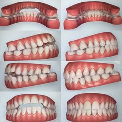 Arrigo Michael P DMD - Very severe Class 3 open bite we started with other Doctors refused to work on due to jaw misalignment.     I want to share these hard case.