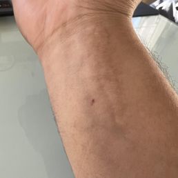 indirect injury from pauls aggresive behavior on my already BROKEN arm with clear surgery marks indirect injury from pauls aggresive behavior on my already BROKEN arm with clear surgery marks
