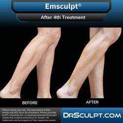 Dr. Sculpt CoolSculpting & EmSculpt Center - After 4th CoolSculpting treatment on calves