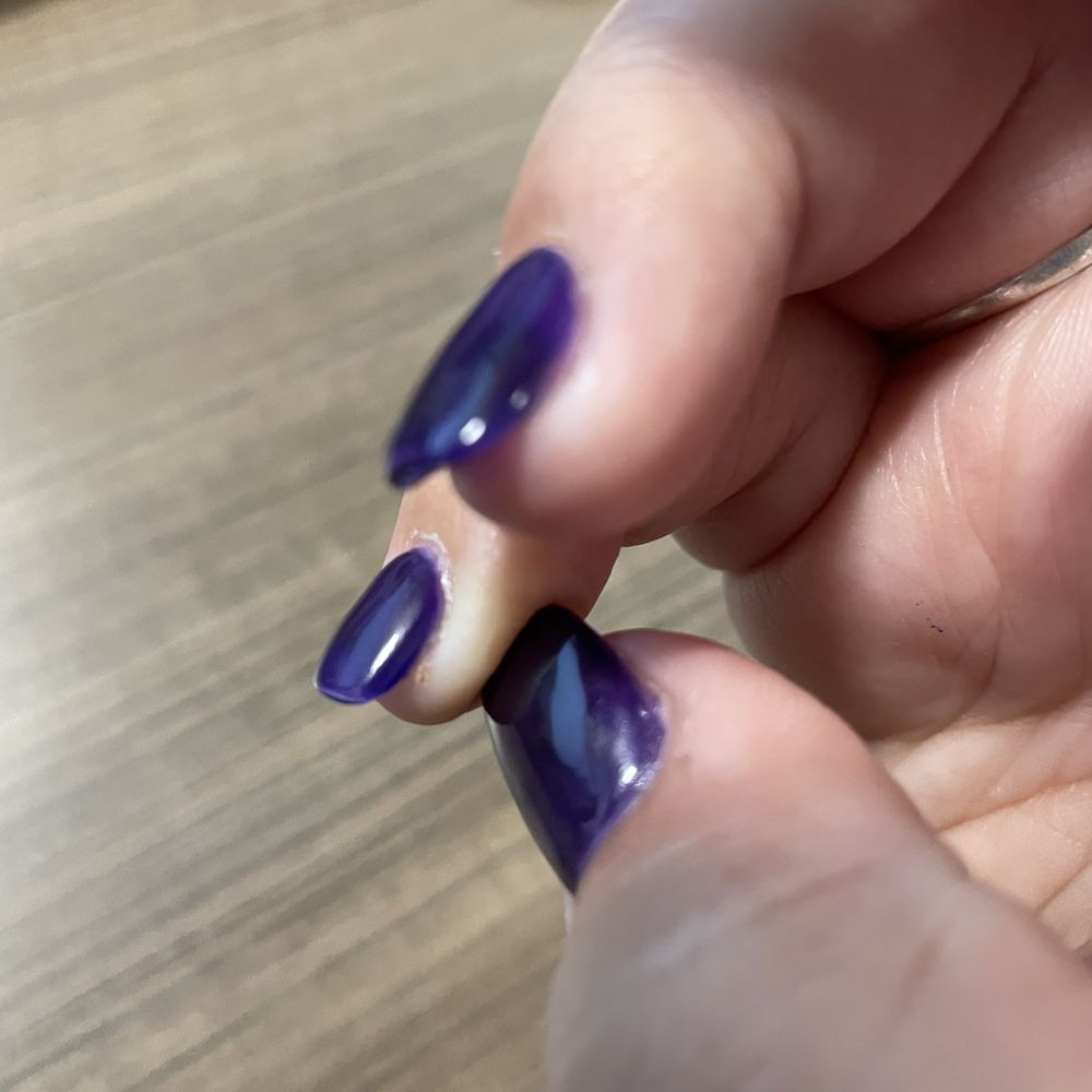 Cut under pinky nail Cut under pinky nail