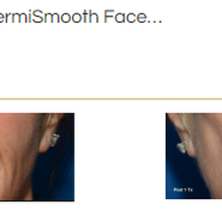 Thaxton Plastic Surgery - ThermiSmooth Face before & after